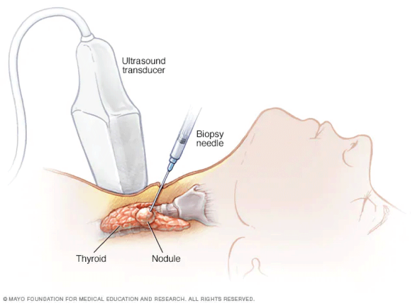 Needle biopsy.