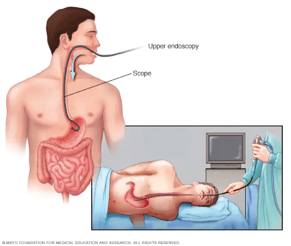 Endoscopic biopsy.