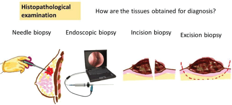 Biopsy samples from patients with suspected or diagnosed cancer.