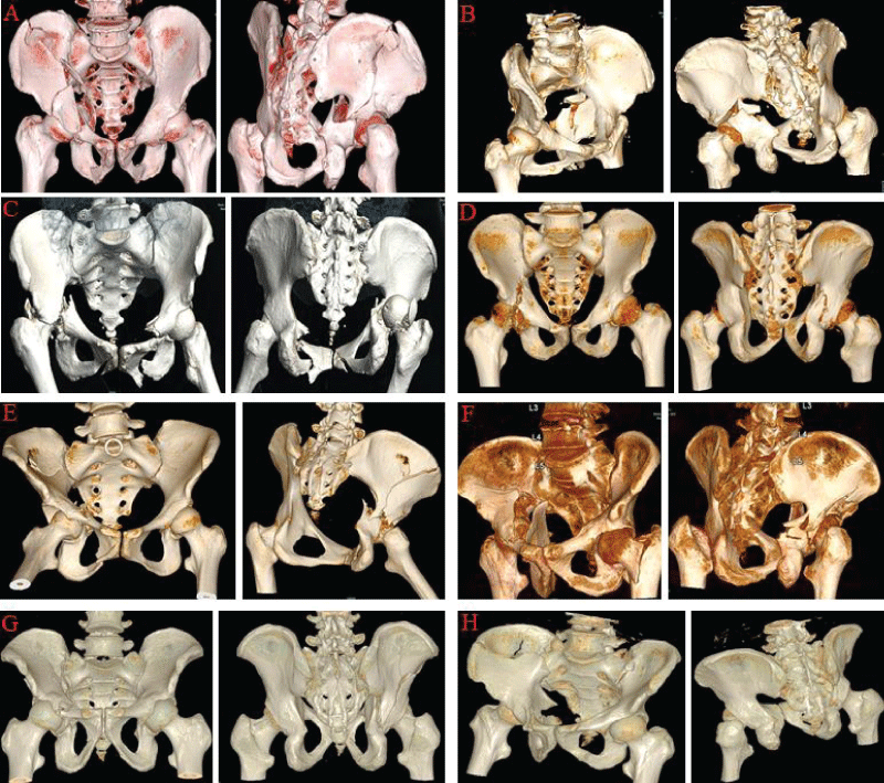Eight traumatic cases admitted for surgical treatment method and classified as follows: A: 55 years old male after traffic accident (A2, P1, Q2, S0, F0). B: 61 years old female after traffic accident (A1, P2, Q2, S0, F0). C: 63 years old female after traffic accident (A2, P2, Q1, S0, F1). D: 49 years old male after traffic accident (A1,P1,Q1,S0, F1). E: 50 years old female after traffic accident (A1, P2, Q1, S1, F0). F: 37 years old male after fall (A1, P1, Q2, S0, F0). G: 35 years old male after traffic accident (A1, P1, Q1, S0, F0). H: 51 years old male after fall (A1, P1, Q1, S0, F0). F0: No femur fracture; F1: femur has fracture or dislocation; A0: no fracture in anterior column; A1: stable fracture in the anterior column; P0: no fracture in posterior column; P1: fracture in the anterior column; P2: unstable fracture in the posterior column; S0: no abnormality in the sacrum; S1: sacrum is affected; Q0: no fracture in the quadrilateral plate; Q1: stable fracture in the quadrilateral plate; Q2: unstable fracture in the quadrilateral plate.