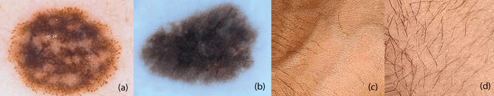 Melanocytic Nevi Classification using Transfer Learning